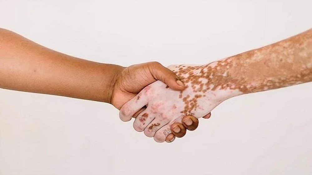 After White Spot Treatment