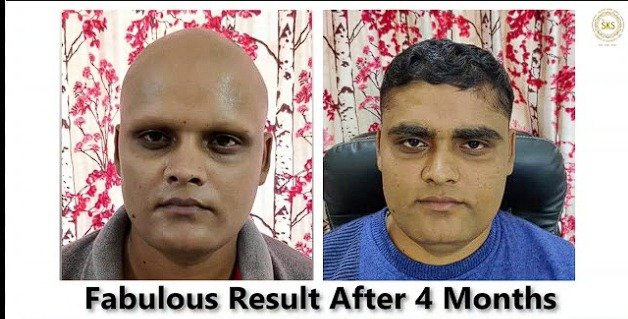After Hair Patch Recovery